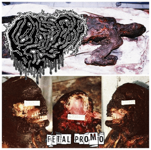 Fetal Deformity : Fetal Promo